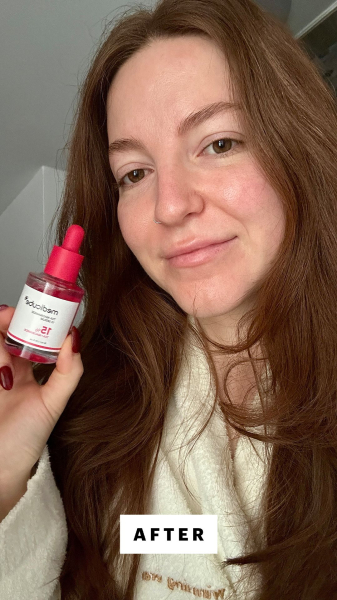 Gulino after applying the Medicube TXA Niacinamide 15 Serum
